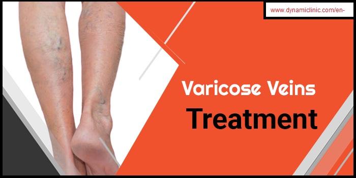 Varicose Veins Treatment in Dubai & Abu Dhabi