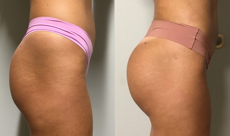 Brazilian Butt Lift Procedure: Benefits, Side Effects, Cost, and more